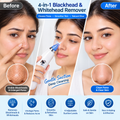 Blackhead remover before and after demonstration with woman using the device